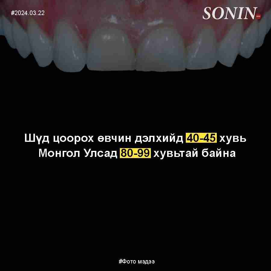 Шүд цоорох өвчин дэлхийд 40-45 хувь байхад Монгол Улсад 80-99 хувьтай байна